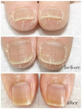 03-4　　ささくれ・皮膚あれ　育成前・結果